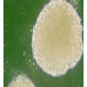 NK-92MI人恶性非霍奇金淋巴瘤患者的自然杀伤细胞